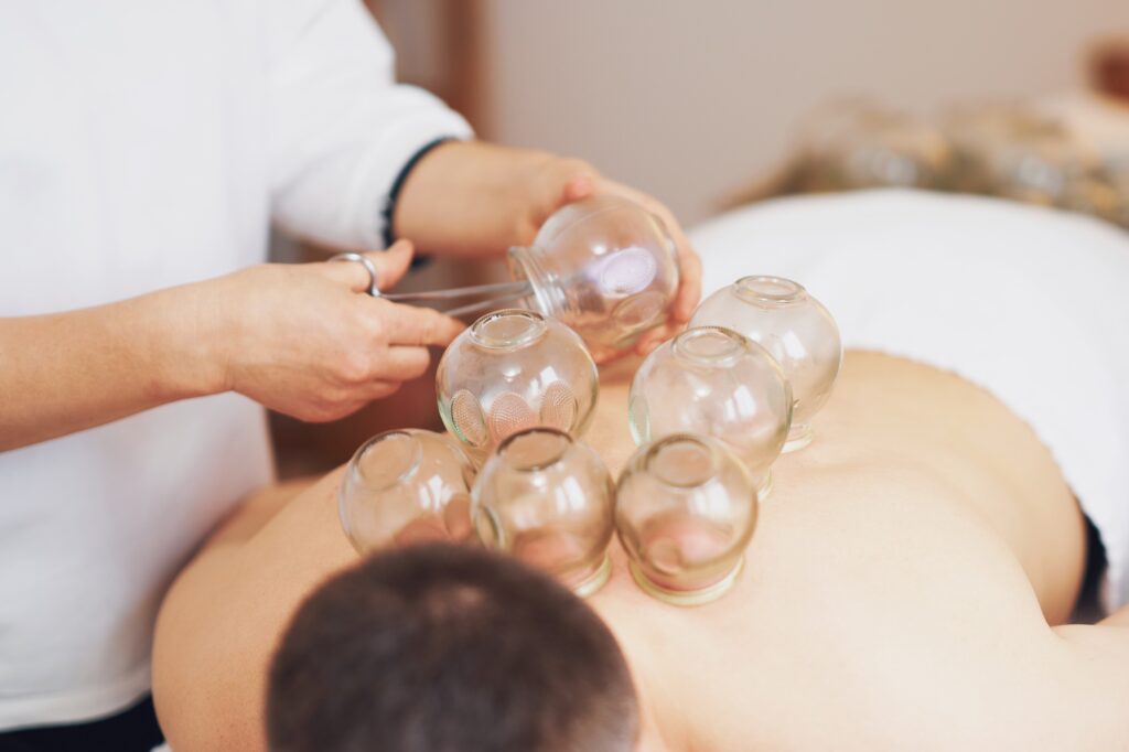 A picture of a man having cupping therapy
