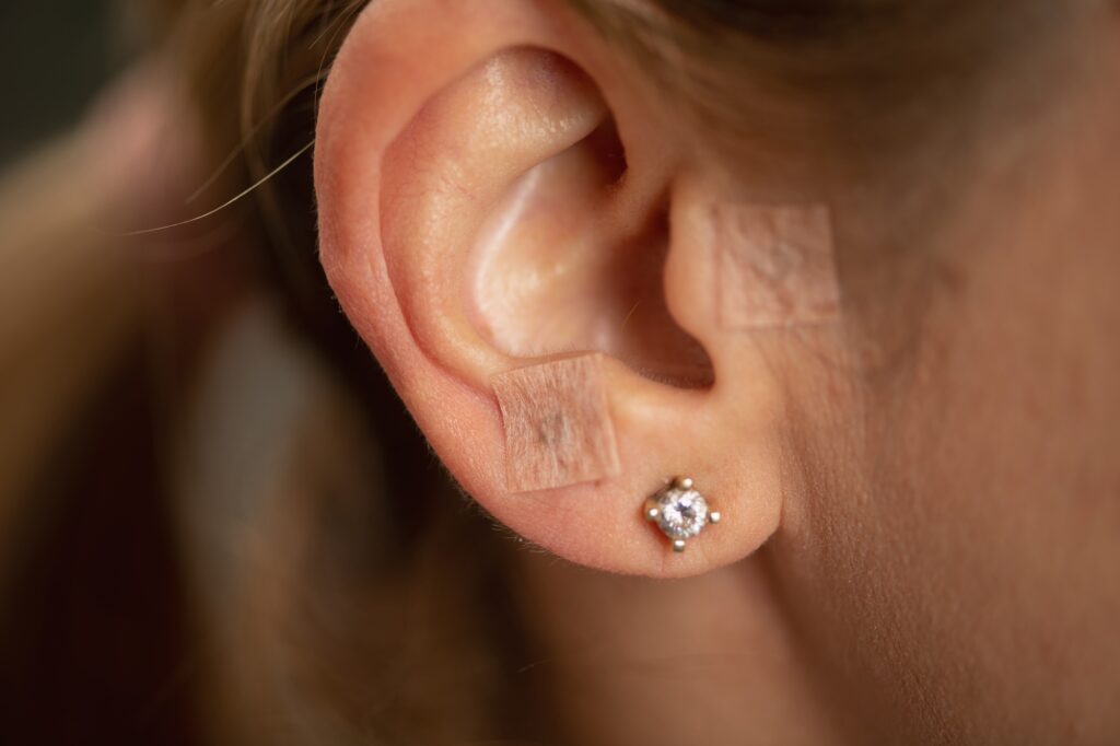Auriculotherapy activates pressure points using ear seeds