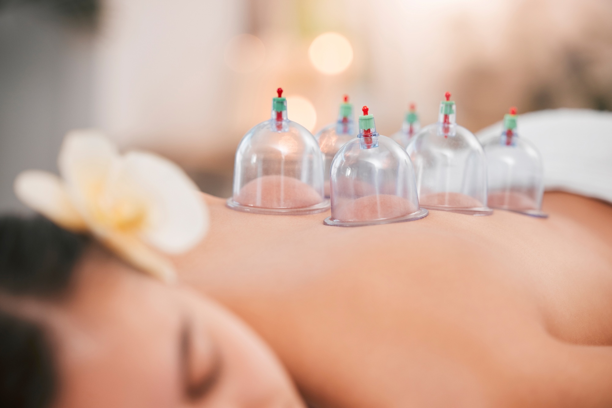 Cupping therapy, spa and zen woman for chinese alternative medicine treatment for back pain and hea